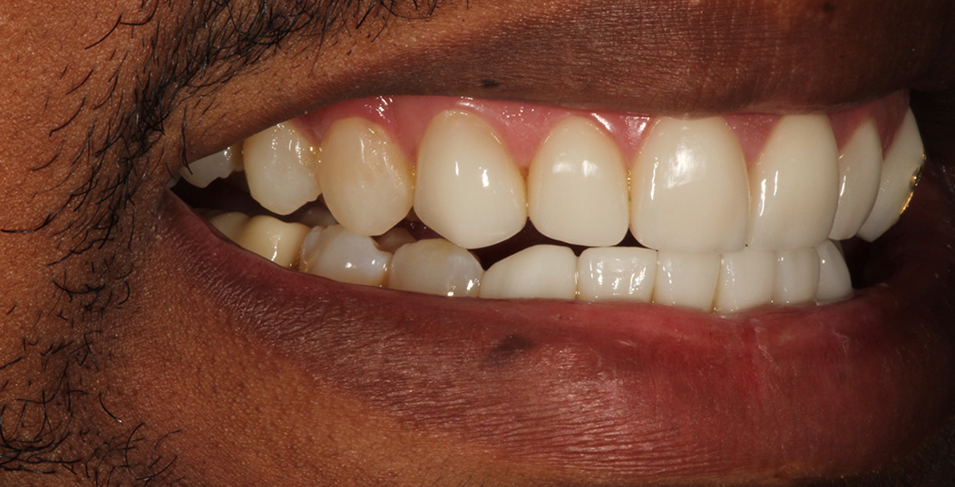 The image shows a close-up view of a person s teeth with a wide smile, displaying yellowed teeth and gums.