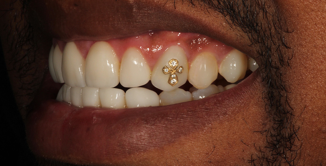 The image features a person with a gold tooth, showing a wide smile with an open mouth.