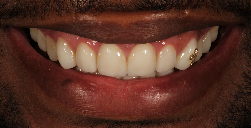 An image of a smiling man with gold teeth, showcasing his bright smile and well-maintained oral hygiene.