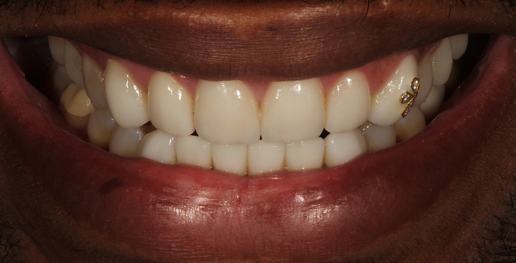 The image shows a close-up of a person s teeth with a gold tooth, smiling broadly at the camera.
