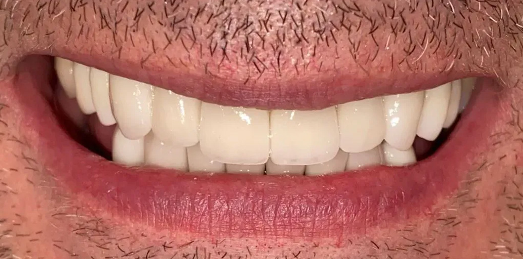 Chroma Dental | Dermal Fillers, Dentures and Smile Rehabilitation