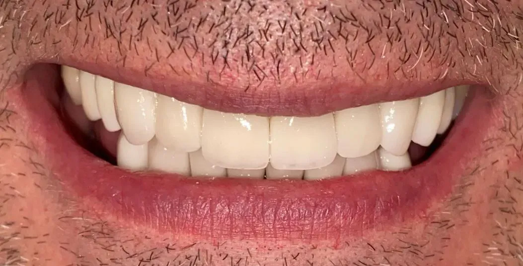 Chroma Dental | Night Guards, Invisalign reg  and Full Mouth Reconstruction