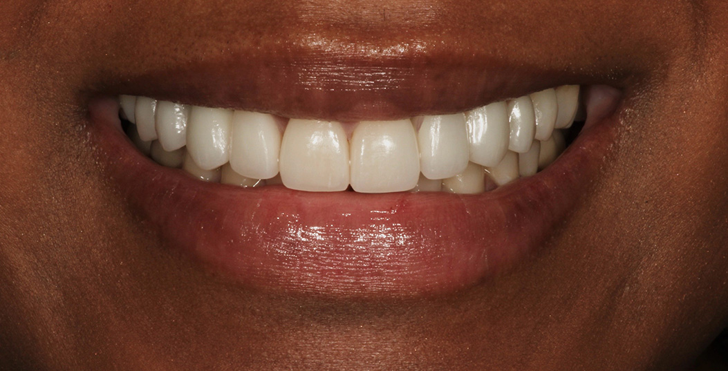 The image shows a close-up of a smiling person with straight white teeth, wearing lipstick, against a neutral background.