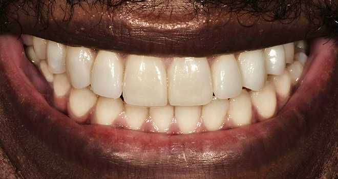 The image shows a close-up of a person's mouth with white teeth, smiling broadly.