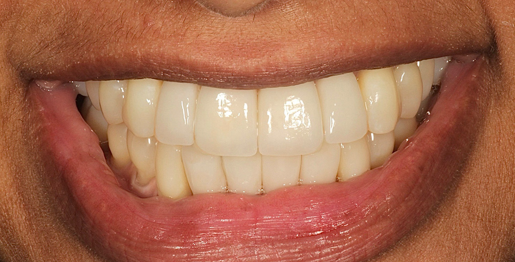 The image shows a close-up of a person's smile with white teeth, featuring a wide grin and a visible tongue.
