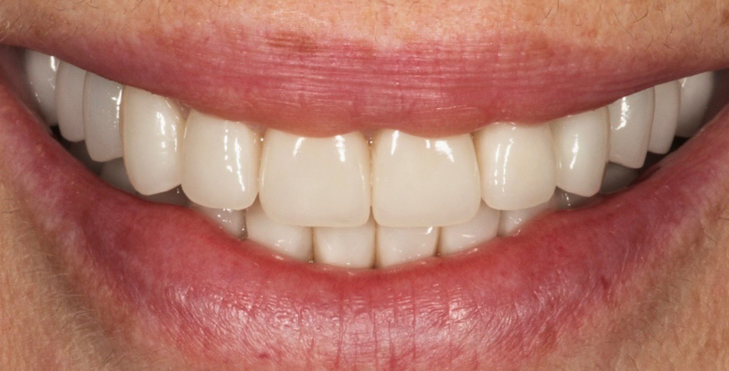 The image shows a close-up of a person's smiling mouth with white teeth and pink gums, set against a plain background.