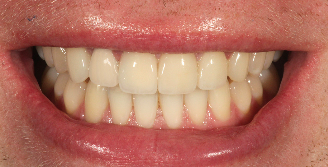 The image shows a person with an open mouth displaying a bright, white smile featuring straight teeth.