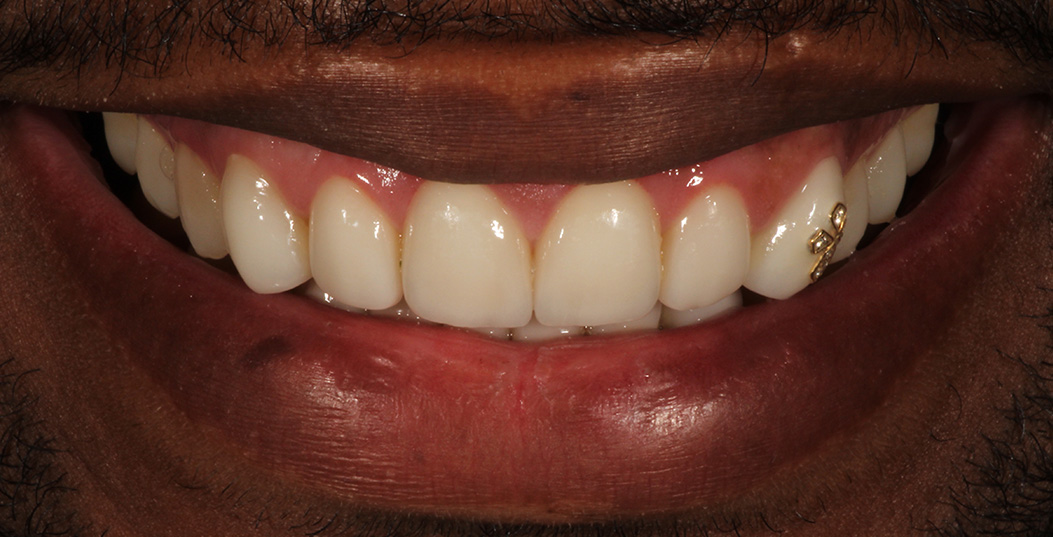 The image shows a person smiling with teeth, displaying a wide grin, and has a mustache and goatee.