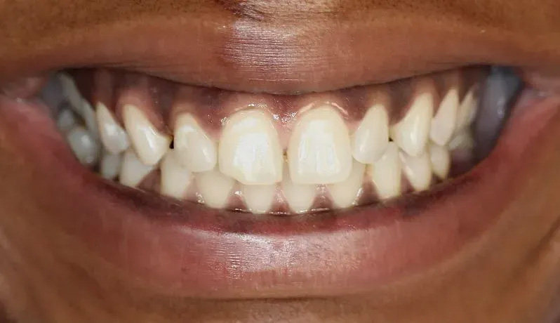Chroma Dental | Night Guards, Oral Surgery and Veneers