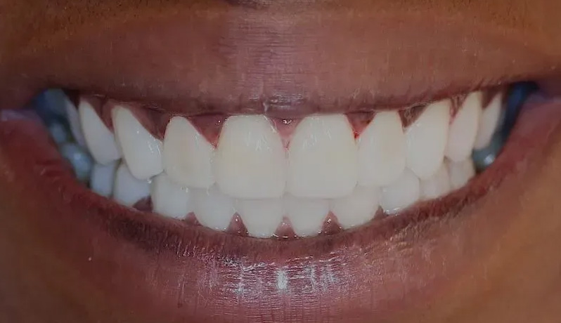 Chroma Dental | Smile Rehabilitation, Fluoride Treatment and Dental Cleanings