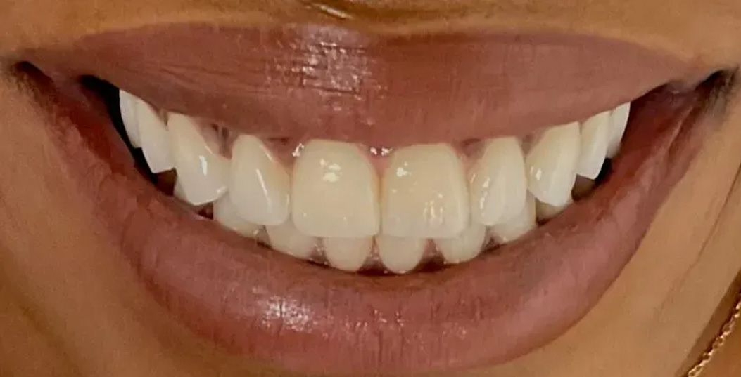 Chroma Dental | TMJ Disorders, Dentures and Veneers