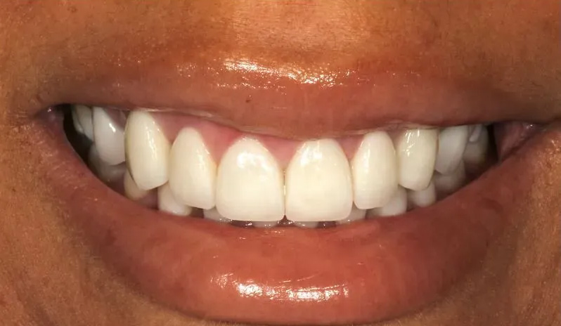 Chroma Dental | Veneers, Root Canals and All-on-6 reg 