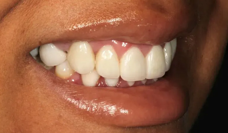 Chroma Dental | Dental Cleanings, ClearCorrect reg  and Sports Mouthguards