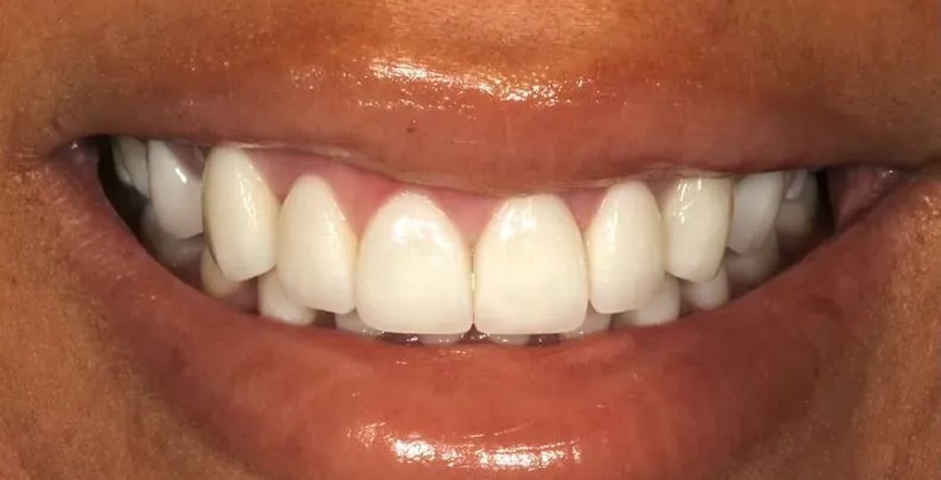 Chroma Dental | ZOOM! Whitening, Dental Fillings and Teeth Whitening