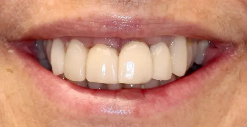 Chroma Dental | Dentures, Digital Impressions and Extractions