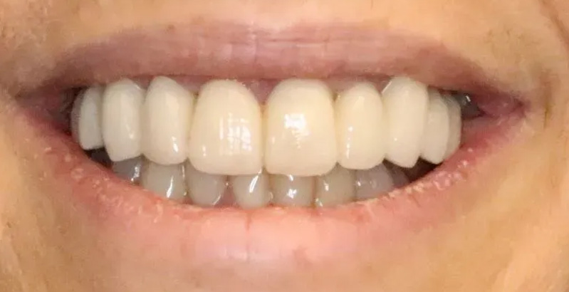 Chroma Dental | Laser Dentistry, Night Guards and All-on-6 reg 
