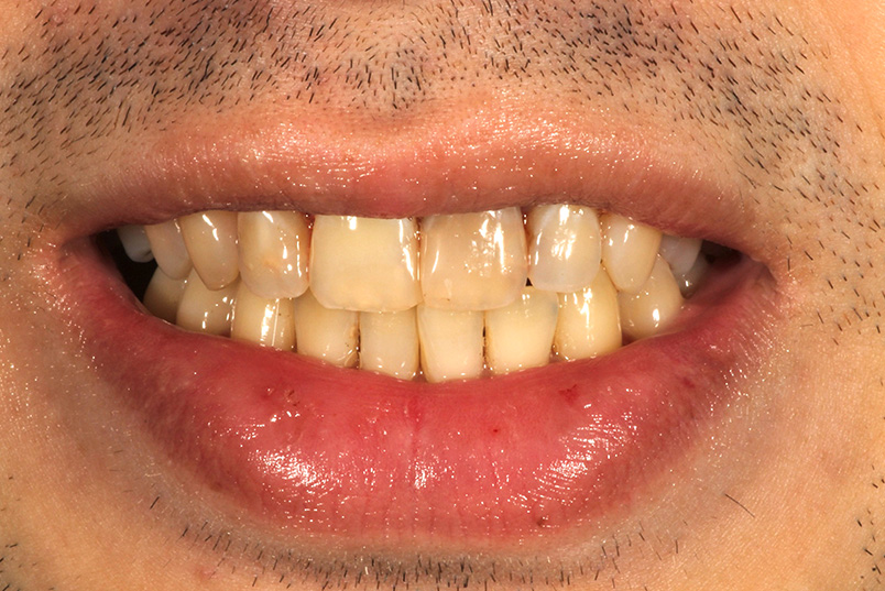 The image shows a close-up of a person s lower face with a smile, displaying teeth that are yellowed and possibly stained, and there appears to be lipstick or a similar substance on the lips. The person has a beard and mustache, and the skin tone is light.