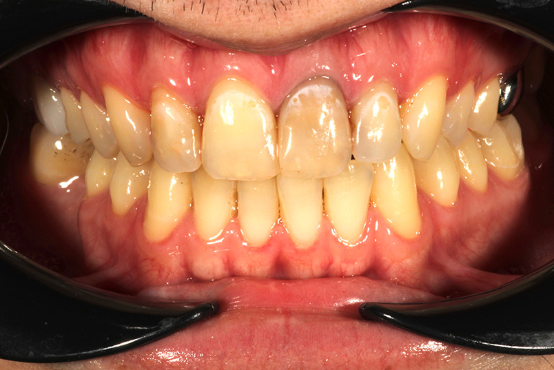 An extreme close-up of a person s mouth showing yellowed teeth with some missing, red gums, and a black object in front of the teeth.