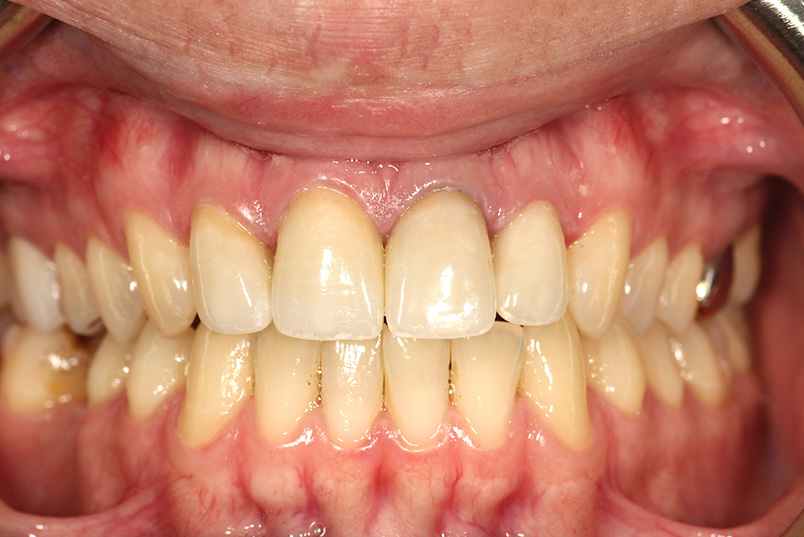 The image shows a close-up view of a person s mouth with yellowed teeth and gums, displaying a wide smile revealing several missing front teeth.