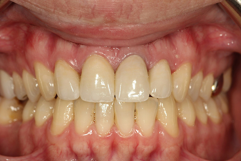 Alt text  Close-up photo of an open mouth showing teeth with yellow stains and tartar buildup.