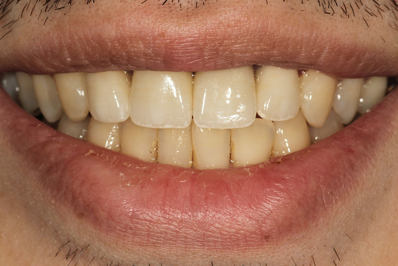The image shows a close-up of a person s mouth with yellowed teeth and a wide smile, set against a blurred background.