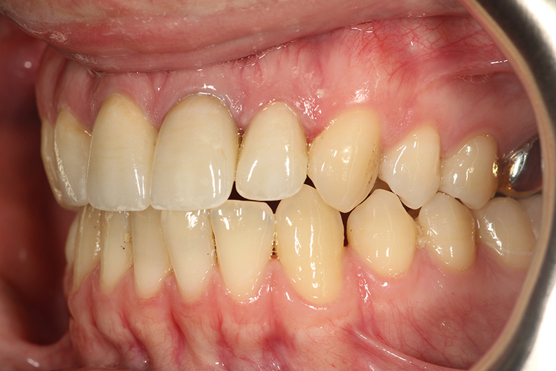 The image displays a close-up view of a person s mouth with an open lower lip revealing teeth that are discolored, likely due to staining or decay, and gums that appear inflamed or diseased.