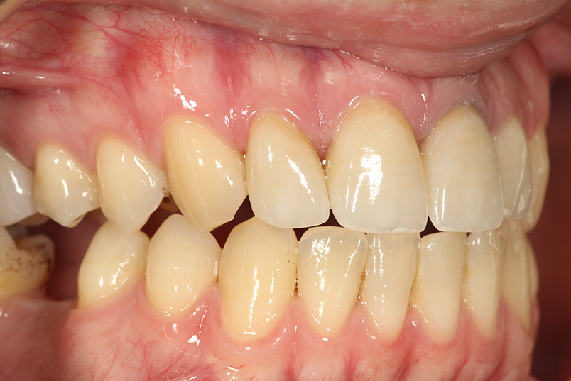 The image shows a close-up view of a person s teeth with a focus on a yellowed front tooth, highlighting dental discoloration.