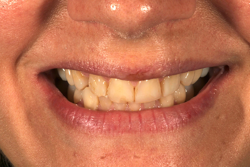 The image shows a close-up of a person s smiling face with visible teeth, focusing on their mouth and teeth.