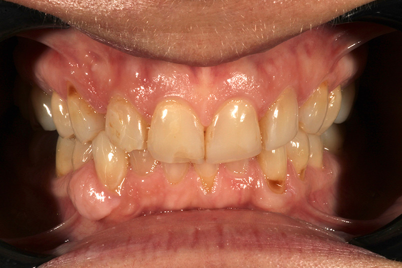The image displays a close-up view of a person s mouth with teeth showing signs of decay and discoloration, which suggests poor oral hygiene or dental health issues.