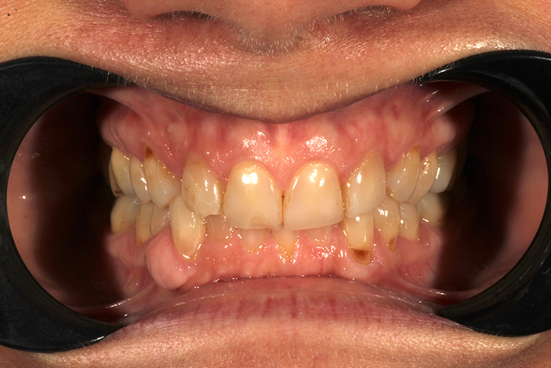 The image shows a close-up view of an open mouth with yellowed teeth, gum inflammation, and a partial denture on the lower front teeth.