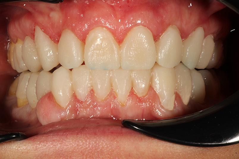 The image shows a close-up of an open mouth with visible teeth and gums, displaying discoloration and staining, against a blurred background.