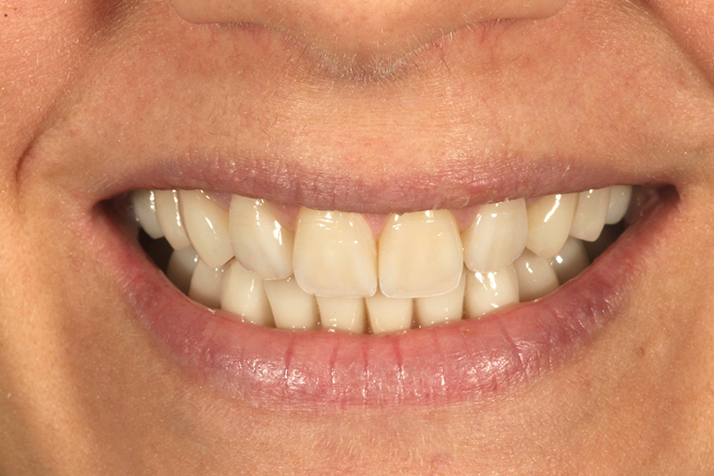 The image features a close-up of a person s mouth with bright white teeth and a smile, set against a neutral background.