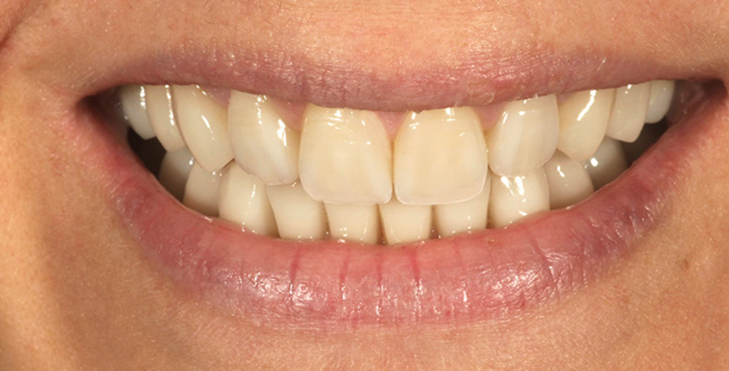 The image displays a close-up of a person's smiling mouth showing a set of clean teeth with a yellowish hue, which could indicate staining or discoloration.