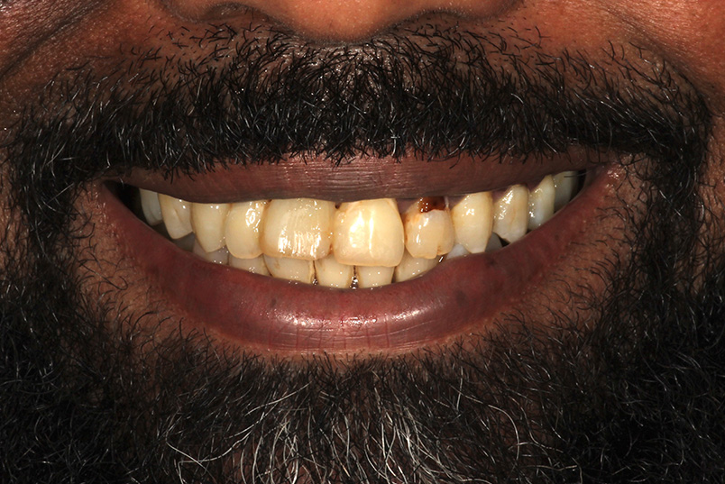 The image shows a man with a broad smile revealing yellowed teeth and a full beard.