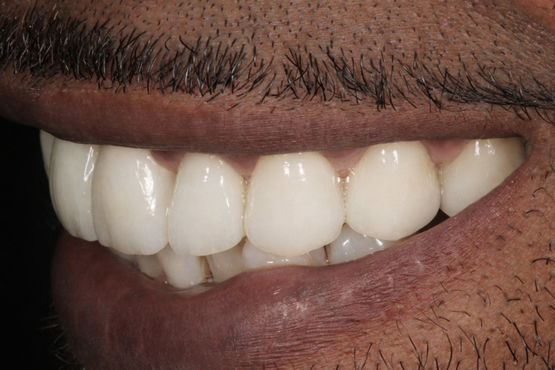 The image shows a close-up of a person s mouth with a wide smile revealing white teeth, set against a blurred background.