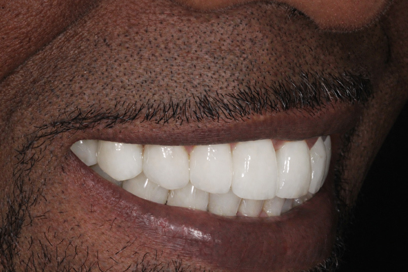 The image shows a close-up of a person s teeth with a smile, with a focus on the mouth area.