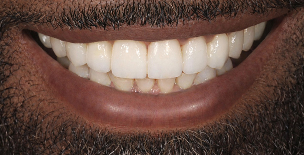 The image shows a close-up of a person with a wide smile, displaying white teeth and a beard.