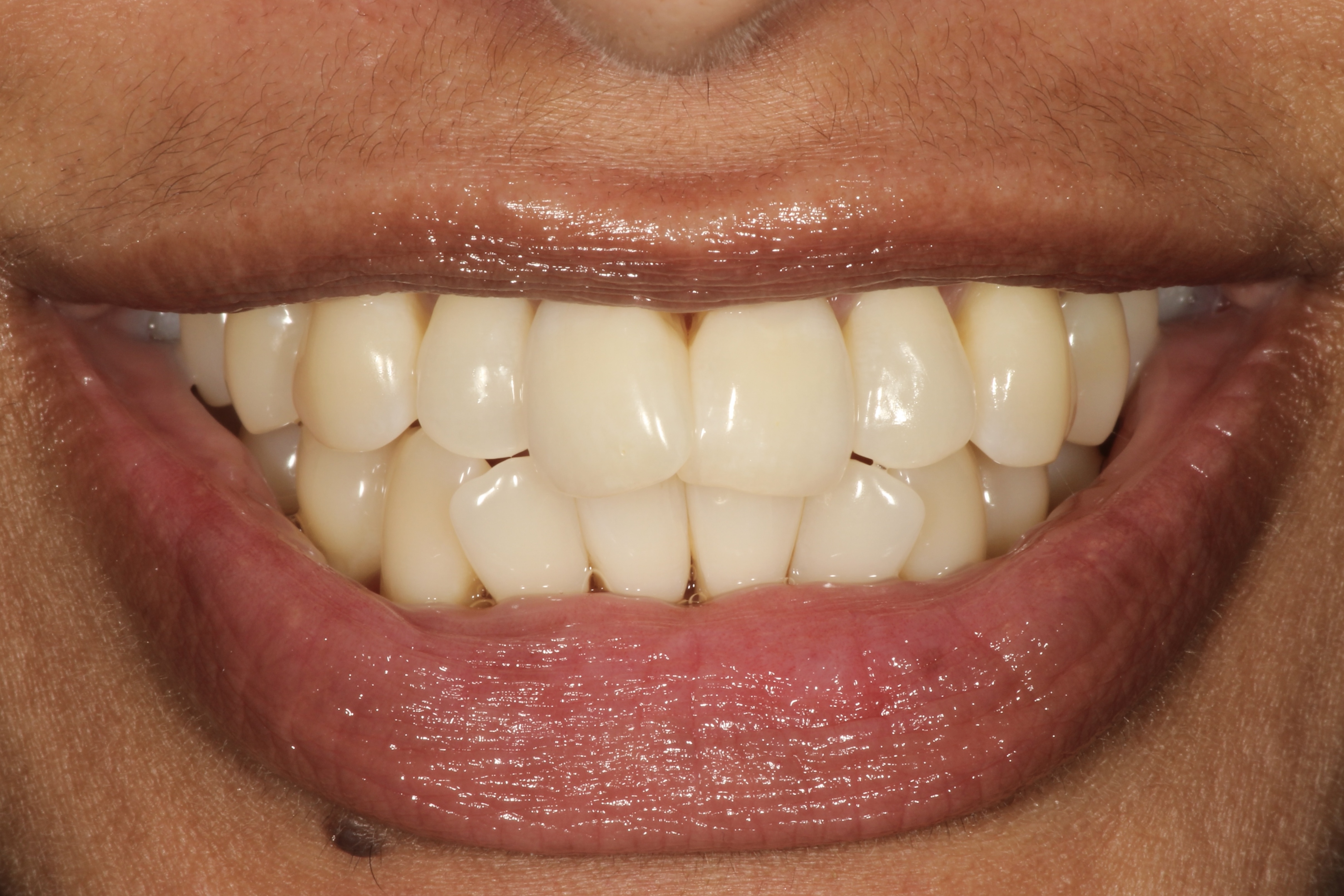 Chroma Dental | Teeth Whitening, ZOOM! Whitening and Smile Rehabilitation