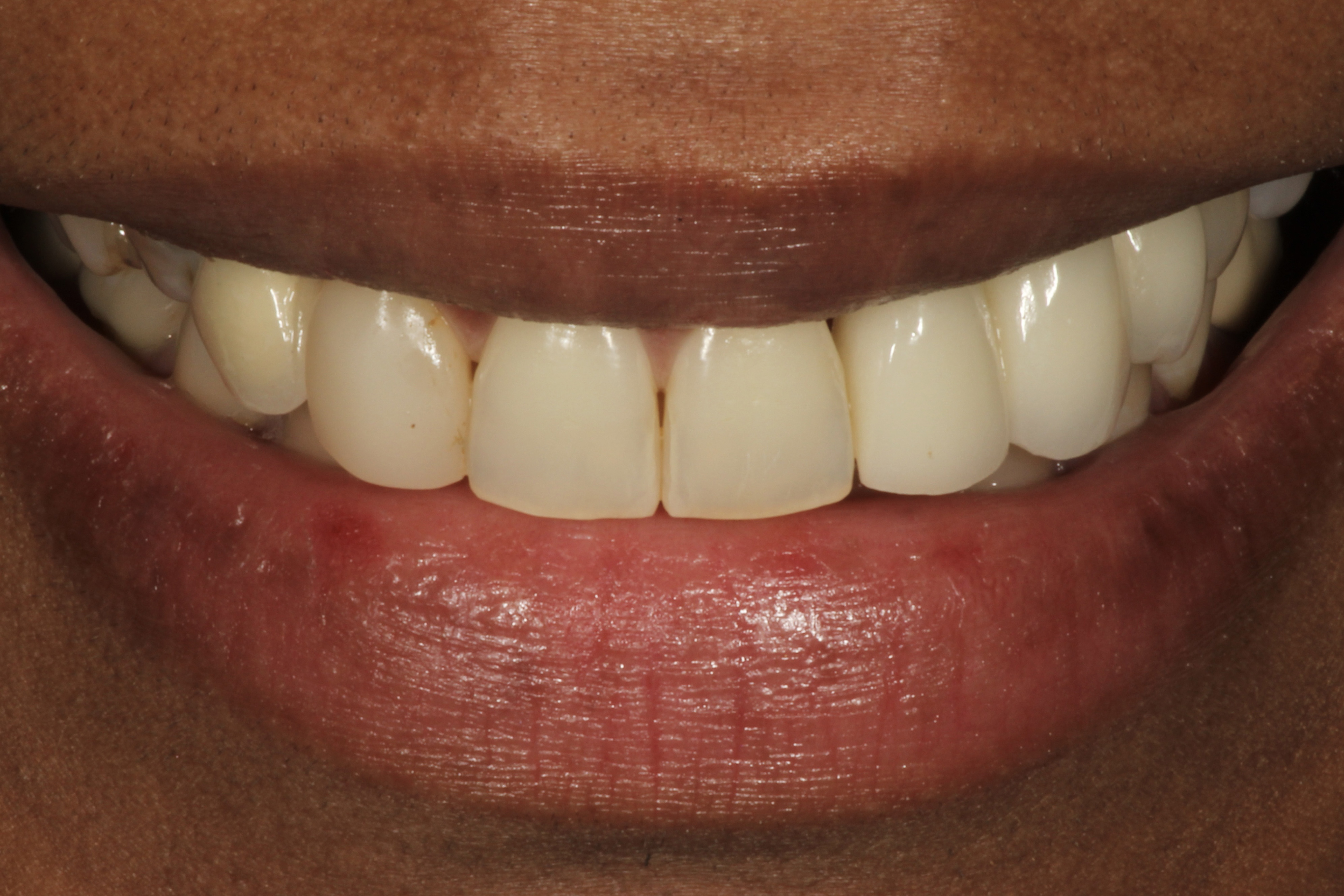 Chroma Dental | Dental Cleanings, Dental Bridges and Root Canals