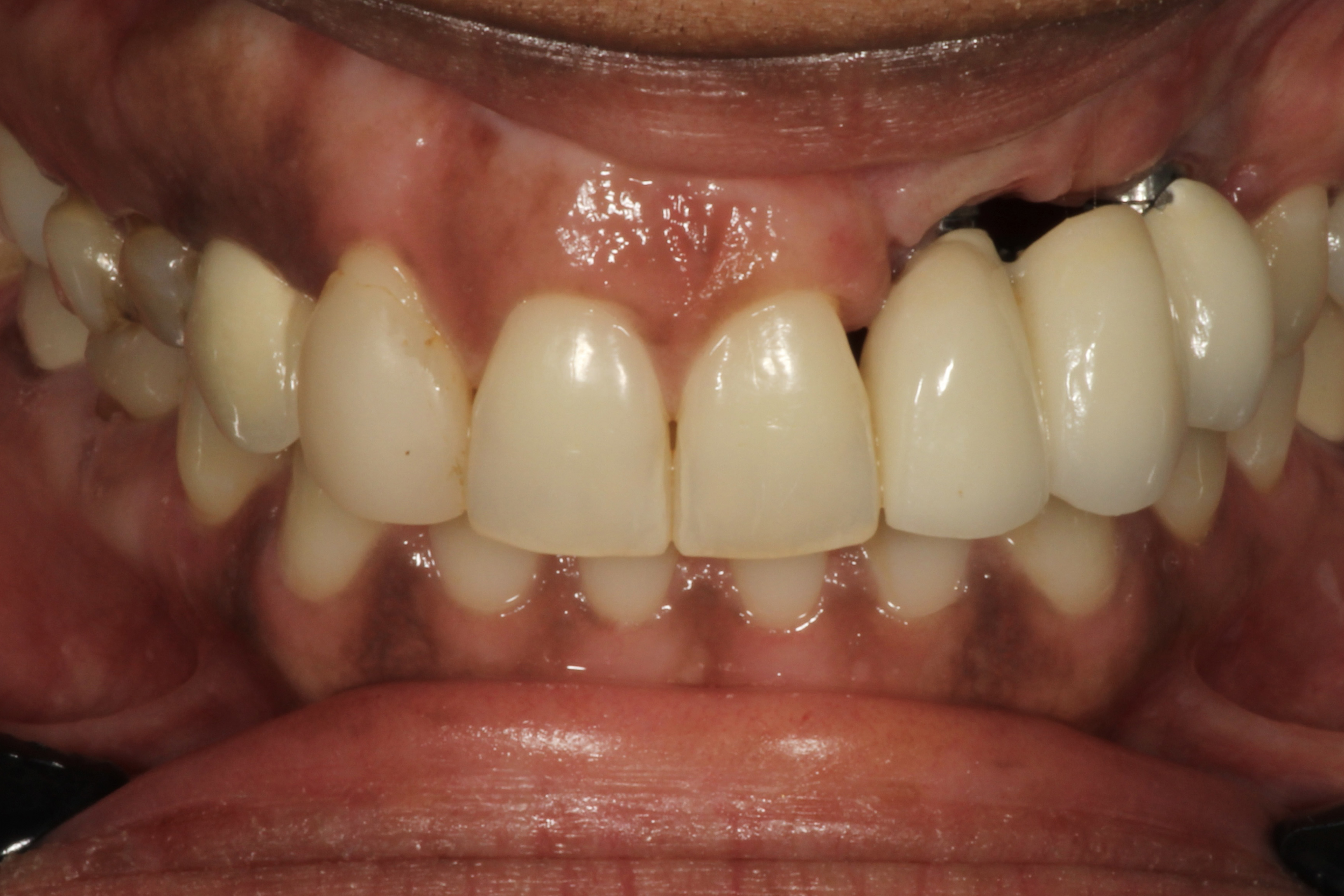 Chroma Dental | Laser Dentistry, Ceramic Crowns and ZOOM! Whitening