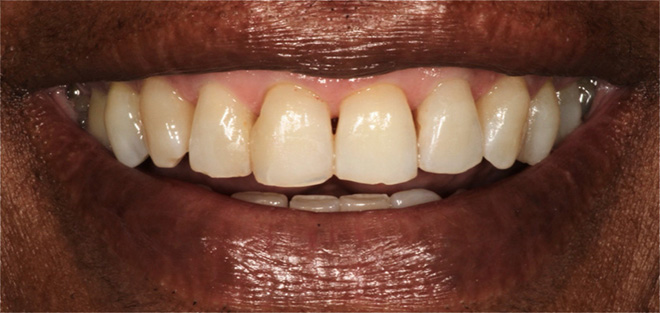 Chroma Dental | Dental Bonding, Dentures and Sleep Apnea