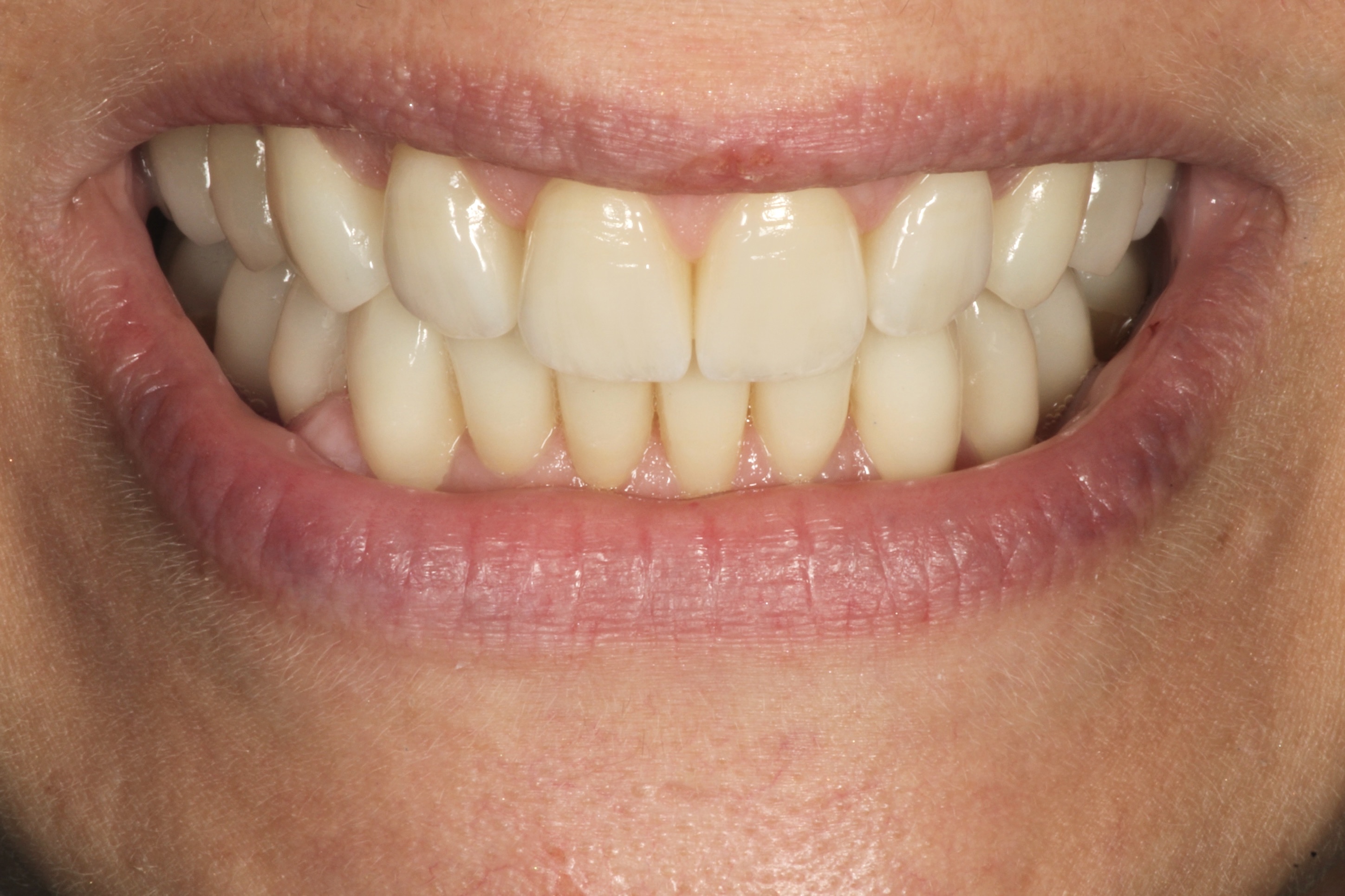 Chroma Dental | Veneers, Intraoral Camera and Dental Sealants