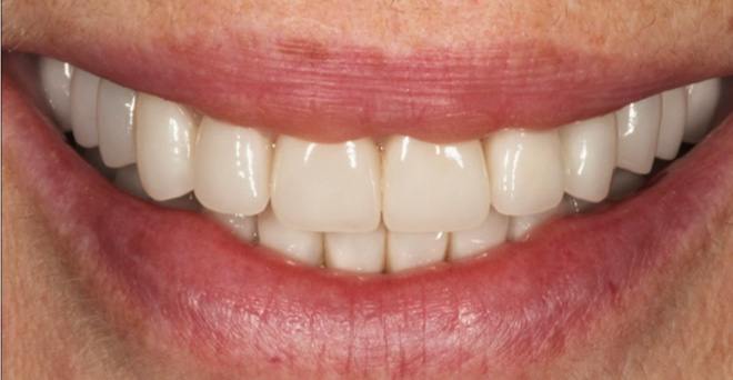 The image shows a close-up of a person s smiling mouth with white teeth, revealing a smile with some gaps between the teeth.