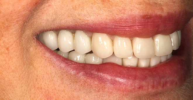 The image displays a close-up of a person's smiling mouth with white teeth, showcasing a wide grin.