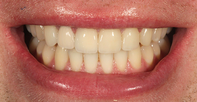 The image shows a close-up of an individual's smiling mouth with yellowed teeth, set against a plain background.