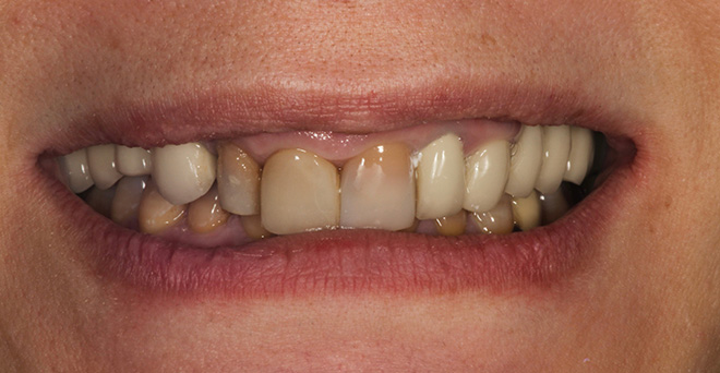 The image shows a person with a wide smile displaying yellowed teeth, which suggests poor oral hygiene or possibly an aging process affecting their dental health.