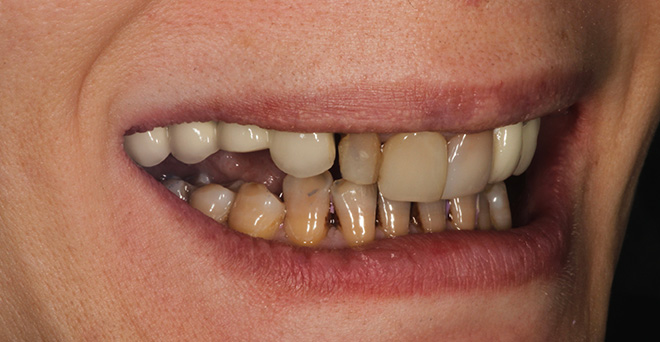 The image shows a person's mouth with an unhealthy set of teeth, including some that appear to be rotten or decaying, and a yellowish-brown stained appearance, possibly due to tobacco use or other oral health issues.