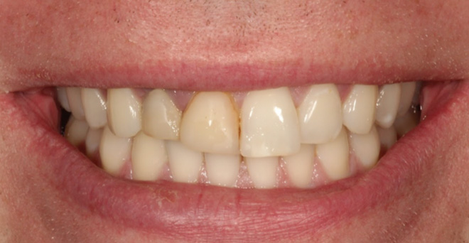 The image shows a close-up of a person's teeth with a wide smile, revealing a yellowed appearance and some dental work.