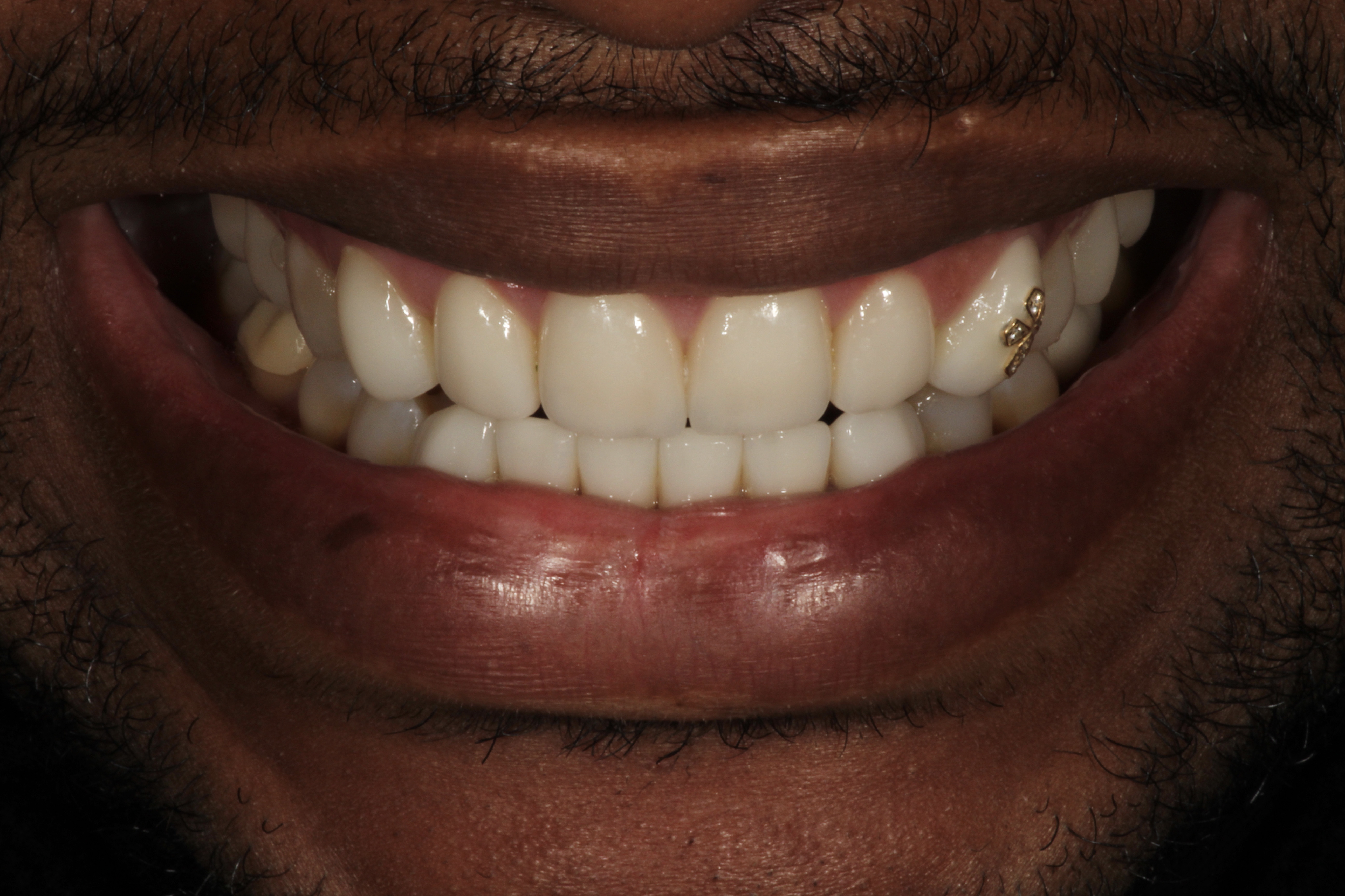 Chroma Dental | Dental Cleanings, Dental Bridges and Root Canals