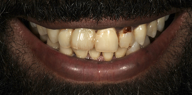 Chroma Dental | Dental Bonding, Emergency Treatment and Dental Cleanings